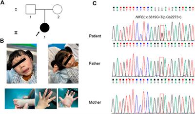 Case report: A novel heterozygous synonymous variant in deep exon region of NIPBL gene generating a non-canonical splice donor in a patient with cornelia de lange syndrome